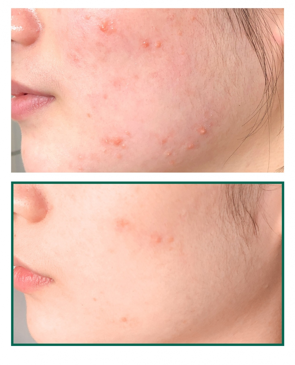 Some By Mi Mousse anti-acné miracle 30 jours AHA BHA PHA Korean Beauty & Healthy LTD